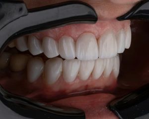 dental bridge